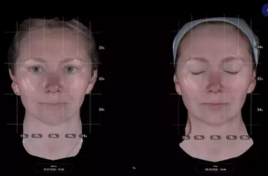 Aesthetic Enhancement: Exploring the Efficacy of XERF for Pre-Wedding Skin Rejuvenation