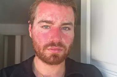 Exercising with Psoriasis: Embracing Activity and Self-Care